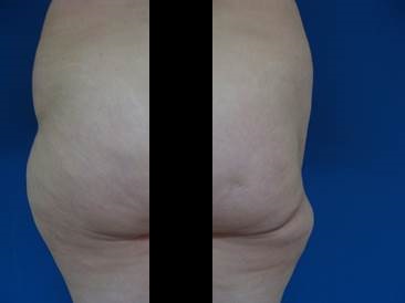 http://image.nauka.bg/bio/med/lozanov/Lipofilling1.jpg