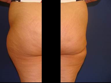 http://image.nauka.bg/bio/med/lozanov/Lipofilling2.jpg